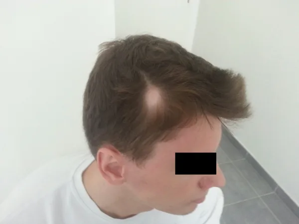 atopické ložosko